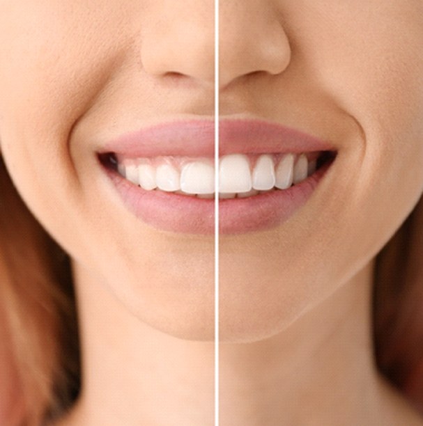 Woman’s smile before and after gum recontouring procedure