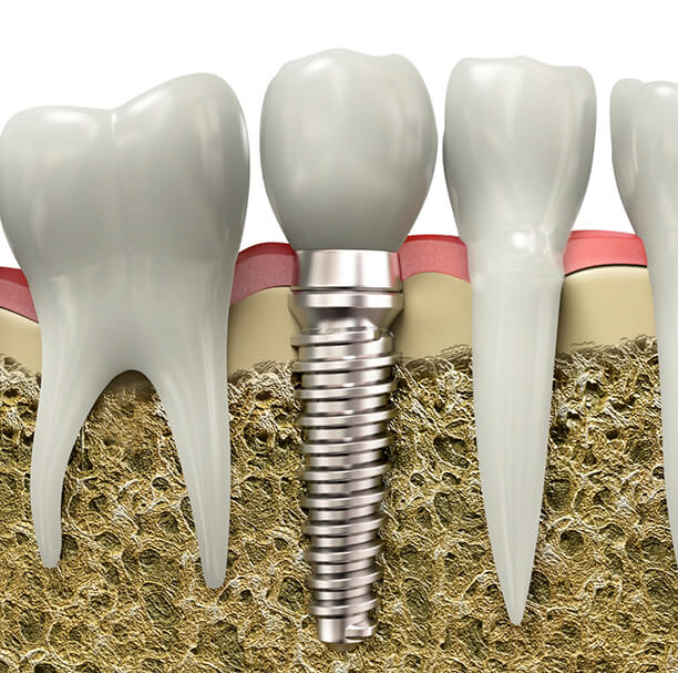 An integrated dental implant in Waupun and Beaver Dam