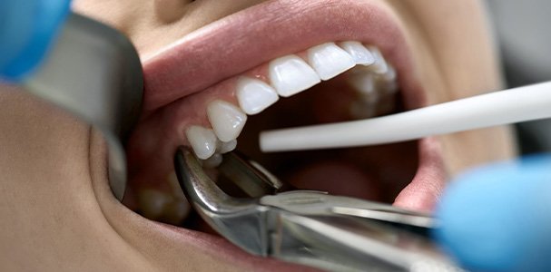 Dental forceps grabbing onto a patient’s tooth