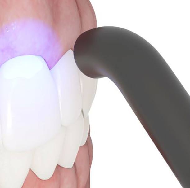 Illustration of curing light hardening dental bonding
