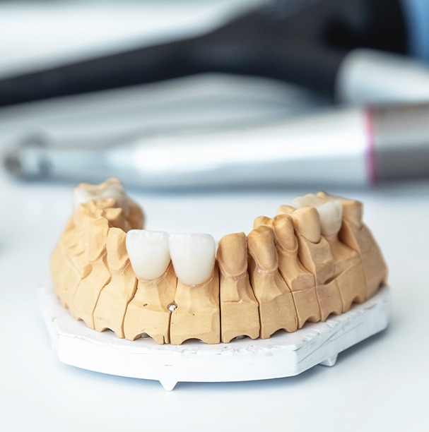 Four CEREC examples