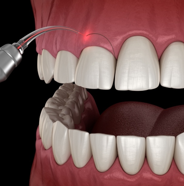 computer illustration of gum recontouring