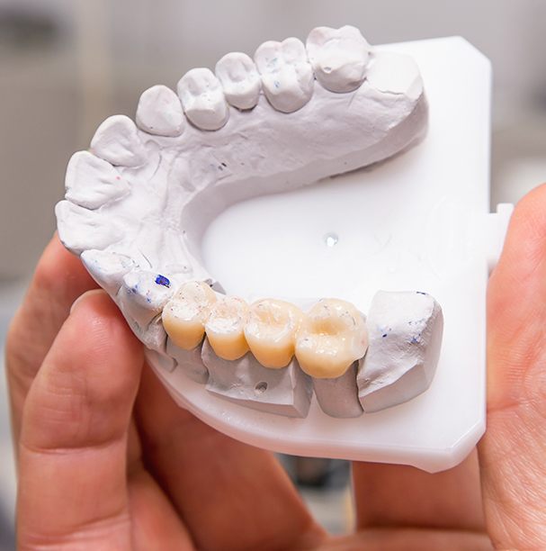 dental bridge mockup