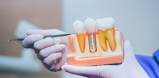 Dentist pointing to a dental implant model