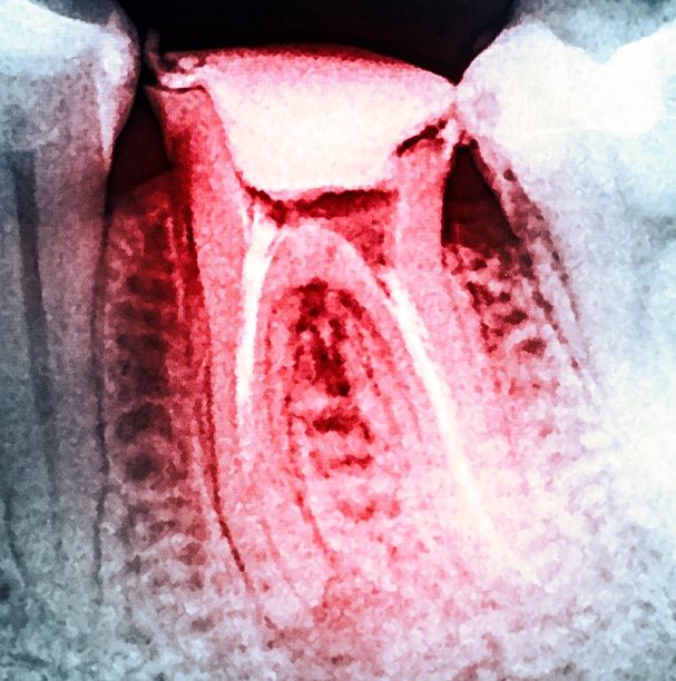 red tooth on x-ray