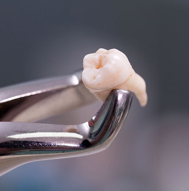 extracted tooth