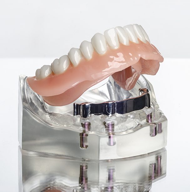 implant denture mockup