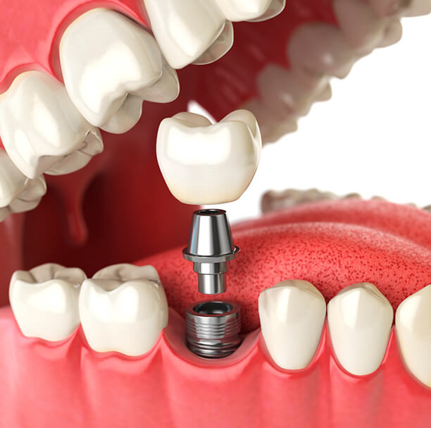 Components of dental implant in Waupun and Beaver Dam