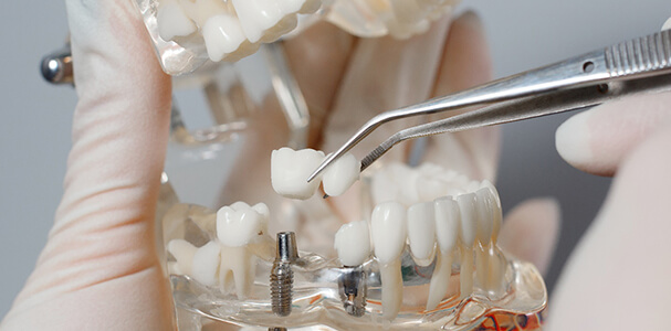 Dentist placing restoration on dental implant in Waupun and Beaver Dam