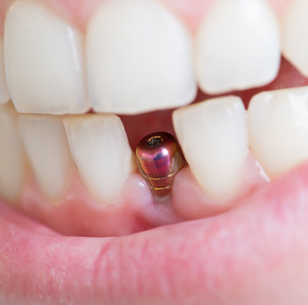 Closeup of integrated dental implant in Waupun and Beaver Dam