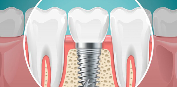 Diagram of an integrated dental implant in Waupun and Beaver Dam
