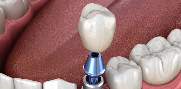 Diagram showing components of a dental implant in Waupun and Beaver Dam