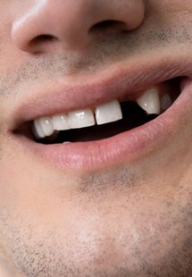 man showing off missing tooth 