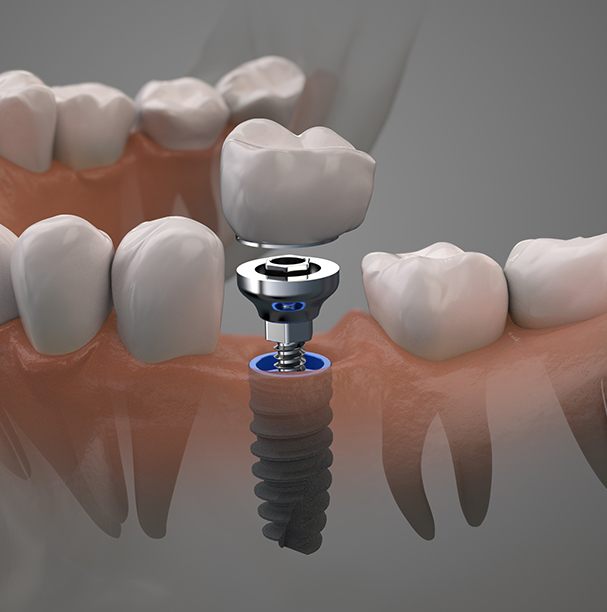 computer illustration of dental implant