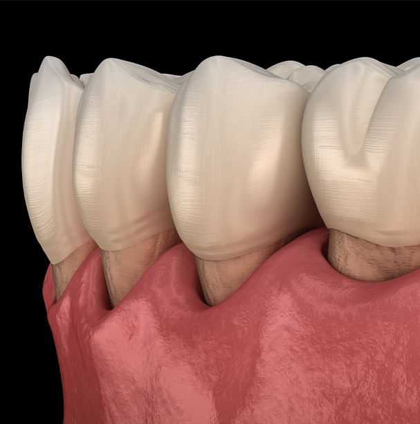 illustration of gum disease