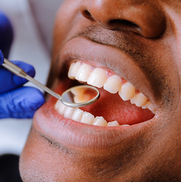 close up of tooth colored fillings