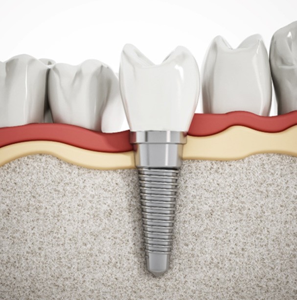 Illustration of dental implant in Waupan, WI