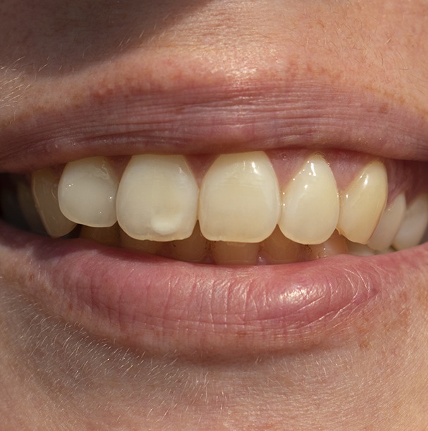 discolored teeth