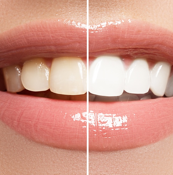 smile split before and after whitening