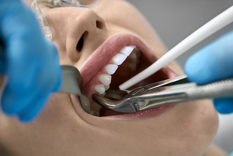 patient with gum disease in Waupun and Beaver Dam having tooth extracted