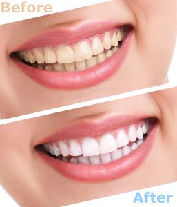 Before and after teeth whitening
