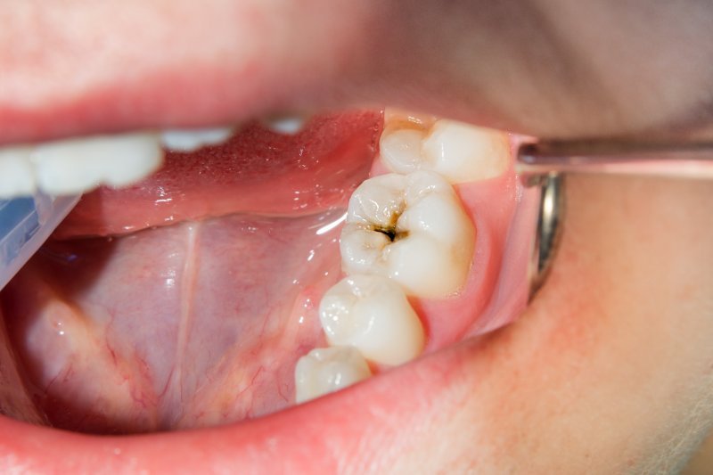 A closeup of a cavity